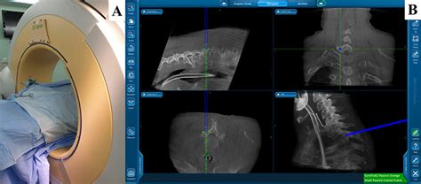 (A) Intraoperative O-arm surgical imaging system. (B) The... | Download ...