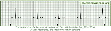 画像をダウンロード sinus bradycardia rhythm 6 second strip 231918