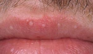 White Bumps on Lips - Causes, Pictures, (Lower, Upper, Inside Lip), Small, Itchy, Get Rid (2022)