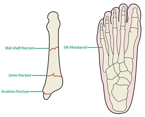 Metatarsal stress fracture causes, symptoms, diagnosis, treatment & prognosis