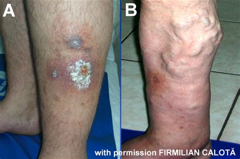 Pathogenesis of the venous ulcer – JOSEF PFLUG VASCULAR LABORATORY