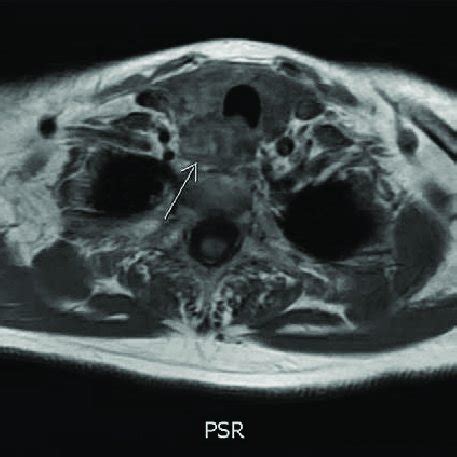 Hypercellular parathyroid gland with central hemorrhage,... | Download Scientific Diagram