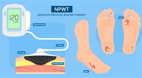 Negative Pressure Wound Therapy: Benefits and Application