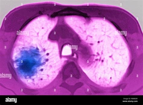 LUNG CANCER MRI Stock Photo - Alamy