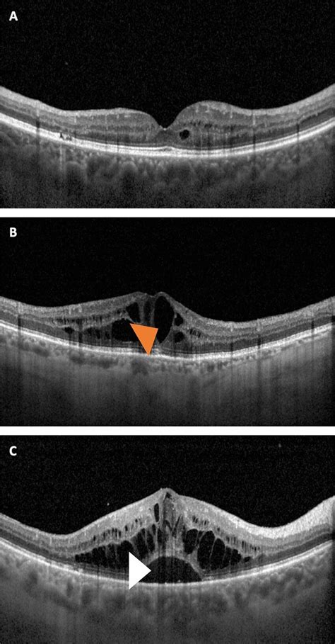 Clinical images showing structural OCT representations of the DME... | Download Scientific Diagram