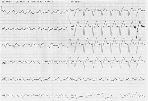 Twelve-lead ECG showing accelerated idioventricular rhythm in a patient ...