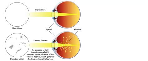 Read Insights about Eye Floaters and Flashes from Auckland Eye