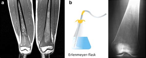 a MRI showing marrow infiltration. b X-ray showing Erlenmeyer flask... | Download Scientific Diagram