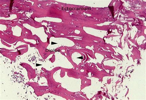 Histological section of the bony nodule perforating the falx cerebri.... | Download Scientific ...