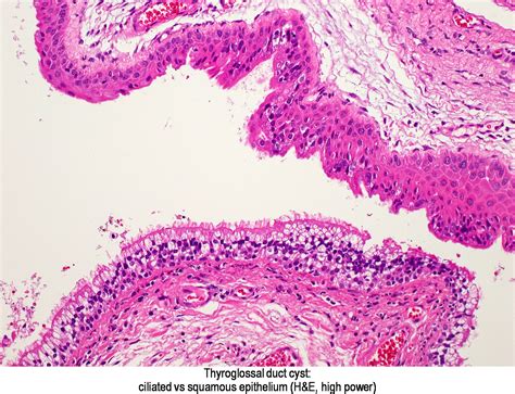 Pathology Outlines - Thyroglossal duct cyst