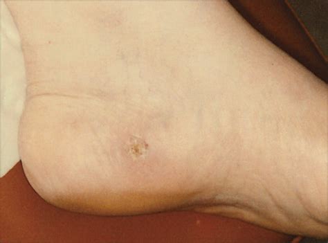 Melanoma of the Foot and Ankle: A Case Series of an Underrecognized Entity | Dermatology | JAMA ...