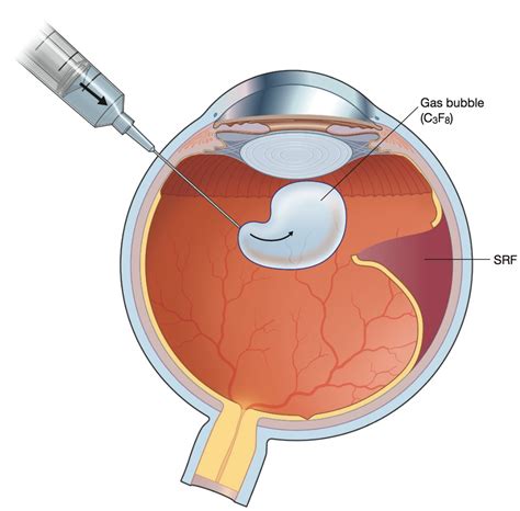 Treatment for Retina Detachment | Surgery