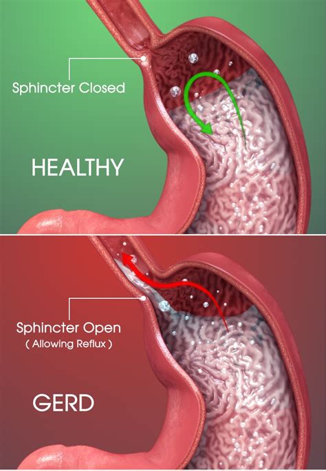 GERD Symptoms but Your Upper Endoscopy Is Normal? Why Is This? » Scary Symptoms