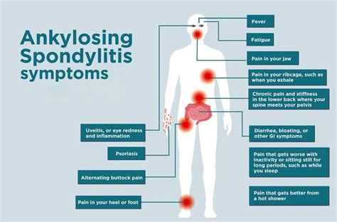 Skin Disorders From Ankylosing Spondylitis: Injury Medical Chiropractic Functional Medicine Clinic