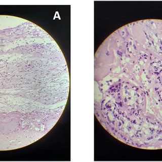 Placental histology Case 1. A. Low resolution: acute chorioamnionitis... | Download Scientific ...