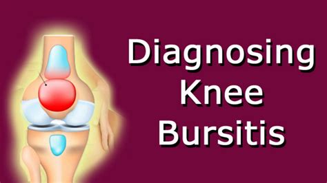 Diagnosing Knee Bursitis - YouTube