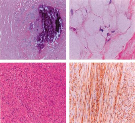 Pathology demonstrates three clearly distinct types of mesenchymal... | Download Scientific Diagram