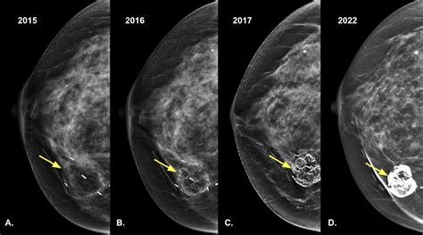 Fat Necrosis of the Breast | Radiology Case | Radshare.net