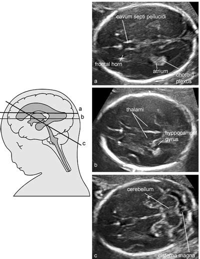 Fetal Brain Ultrasound Images