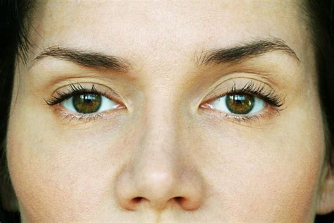 Questions about Droopy Eyelid Surgery Answered - Allure Plastic Surgery
