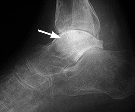 Avascular Necrosis of Talus - Causes and Treatment | Bone and Spine