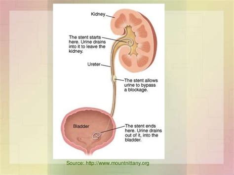 management of upper urinary obstruction