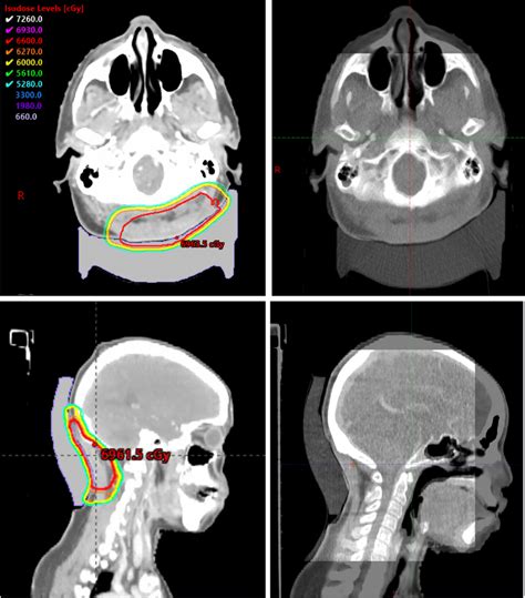 Cone Beam Radiation Therapy - The Best Picture Of Beam