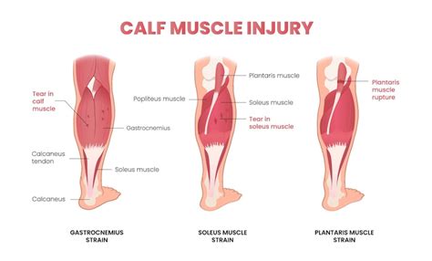 Premium Vector | Calf muscle injury infographic