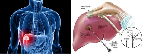 Liver Cancer | Varicose veins | Vascular surgeon | Stroke | DVT | Leg gangrene | Cancer