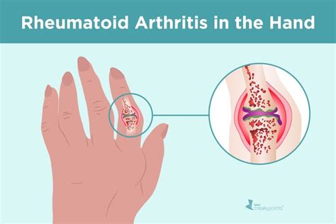 Rheumatoid Arthritis in the Hands: Symptoms and Treatments