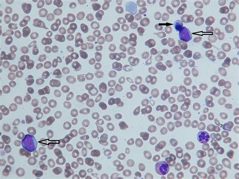 Myelofibrosis - Oxford Medical Education