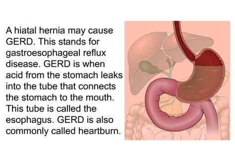 PatEdu.com : Hiatal Hernia