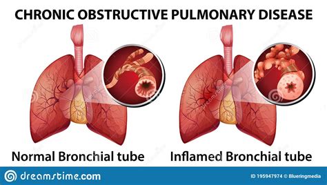 Chronic Obstructive Pulmonary Disease Stock Vector - Illustration of diagram, alveoli: 195947974