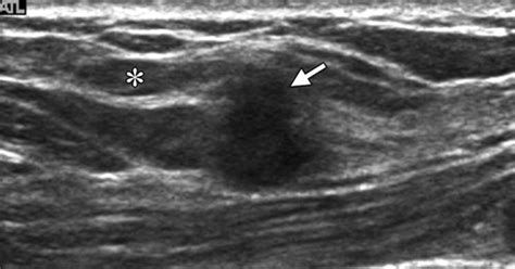 How to Find an Isoechoic Lesion with Breast US | RadioGraphics