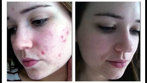 Skin Care Routine Before and After - YouTube