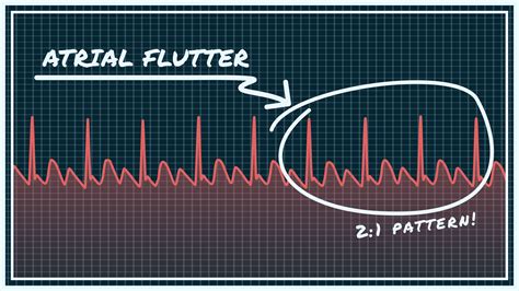 Atrial Fibrillation Vs Atrial Flutter Ecg