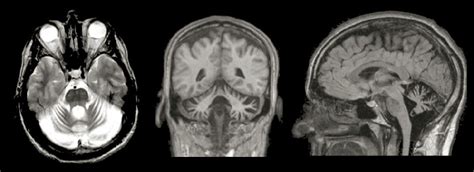 Cerebellar Vermis Atrophy