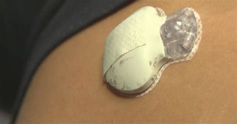 'Artificial Pancreas' Expected To Make Life Easier, Healthier For Type 1 Diabetes Patients - CBS ...