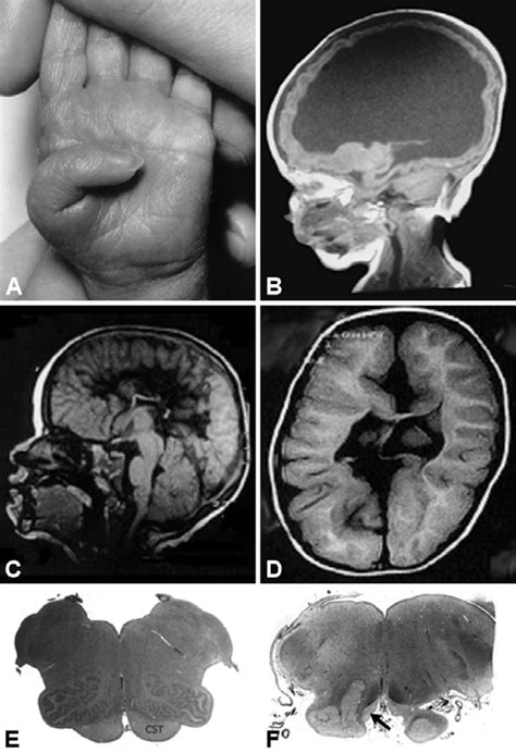 Patients with syndromes of the L1 spectrum. A: Adducted thumb of an... | Download Scientific Diagram