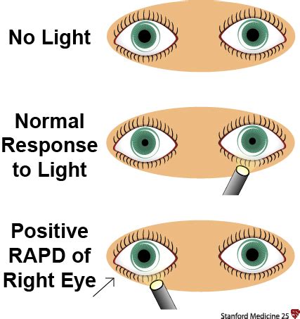 Relative Afferent Pupillary Defect – Stepwards