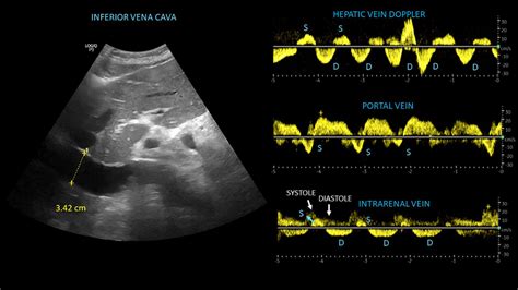 Inferior vena cava ultrasound and venous Doppler patterns from the... | Download Scientific Diagram