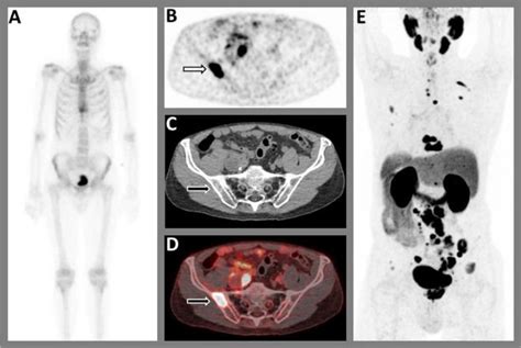 Is PSMA PET/CT More Beneficial than Bone Scintigraphy in Detecting Bone ...