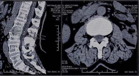 Ct Scan Spine