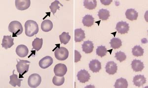 Echinocytes – Cells and Smears