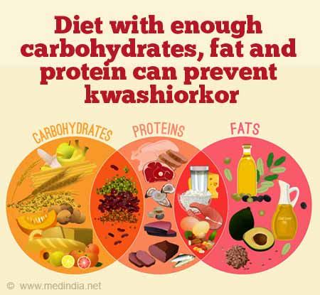 Marvelous Info About How To Prevent Kwashiorkor - Fewcontent