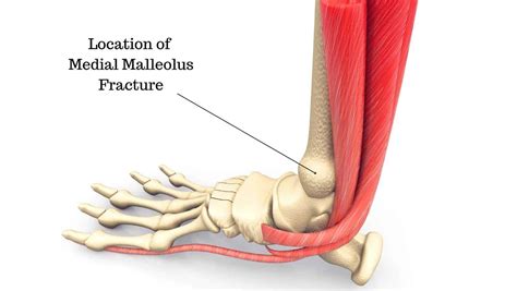 Causes of Inner Ankle Pain Explained by a Foot Specialist