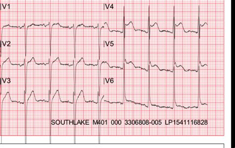 Dr. Smith's ECG Blog: Is it early repol, pericarditis, or anterior STEMI?