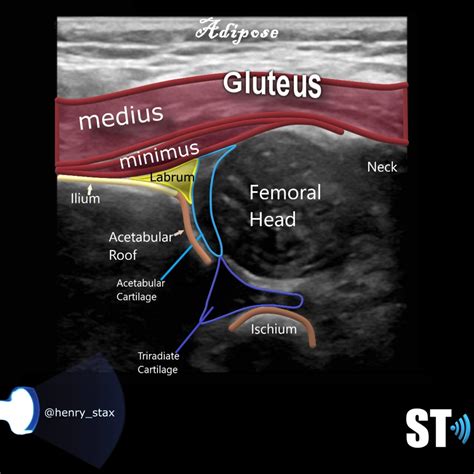 Neonatal Hip Ultrasound – Sonographic Tendencies