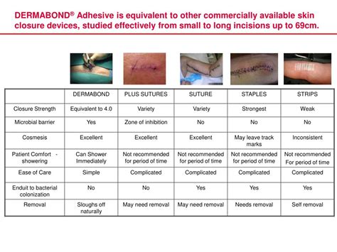 PPT - DERMABOND ® Topical Skin Adhesive PowerPoint Presentation, free download - ID:1396864