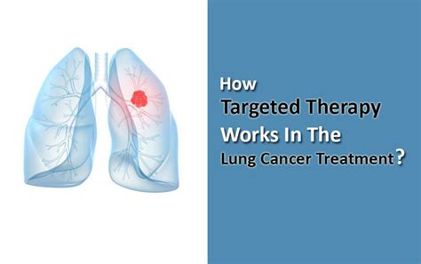 How Targeted Therapy Works In The Lung Cancer Treatment? - HBG Medical ...